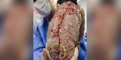 Caso raro: Bebê nasce com DIU grudado nas costas no DF