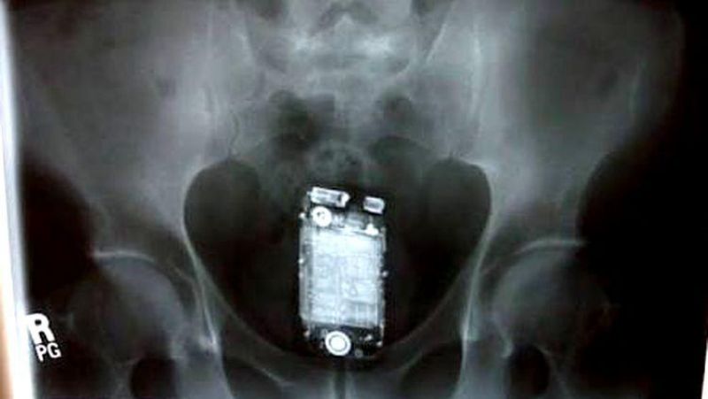 NO ÂNUS: Apenado é submetido a cirurgia para retirar celular escondido