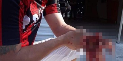 Rojão explode e amputa a mão de torcedor do Athletico-PR 