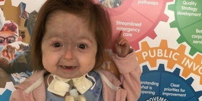 CASO RARO: Menina é a única no mundo a ter a doença de Benjamin Button CASO RARO: Menina é a única no mundo a ter a doença de Benjamin Button