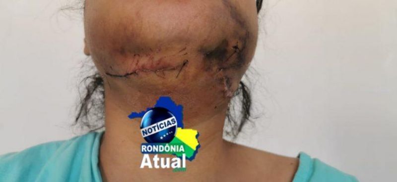 Suspeito de quebrar maxilar de mulher e provocar perda de bebê em gestação é preso, em Ji-Paraná Suspeito de quebrar maxilar de mulher e provocar perda de bebê em gestação é preso, em Ji-Paraná