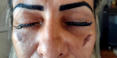 Mulher sofre lesões nos olhos após colocar cílios postiços em clínica de estética...