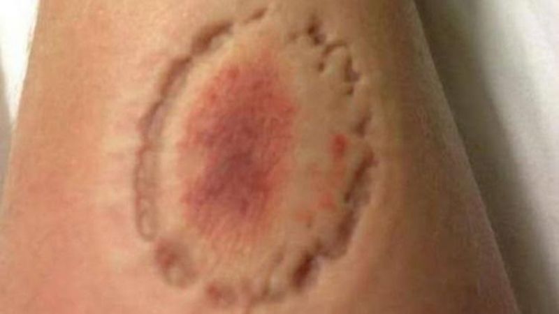 Marido é agredido com tesourada e mordidas pela mulher após discussão Marido é agredido com tesourada e mordidas pela mulher após discussão