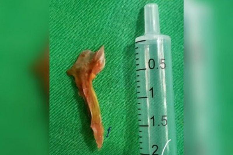 Idoso morre após engolir osso de peixe de 2 cm e perfurar intestino Idoso morre após engolir osso de peixe de 2 cm e perfurar intestino