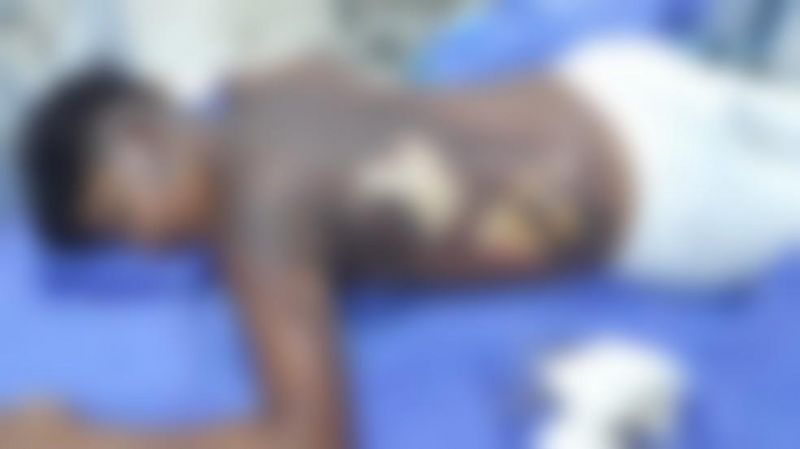 Adolescente de 13 anos sofre queimaduras graves pelo corpo e é levado ao hospital Adolescente de 13 anos sofre queimaduras graves pelo corpo e é levado ao hospital