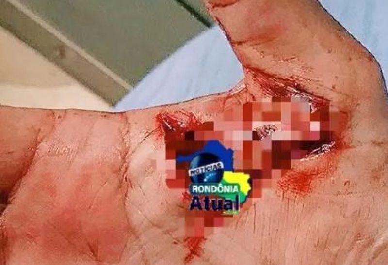 Mulher é atendida no HM de Ji-Paraná após ser agredida com faca por sua companheira Mulher é atendida no HM de Ji-Paraná após ser agredida com faca por sua companheira
