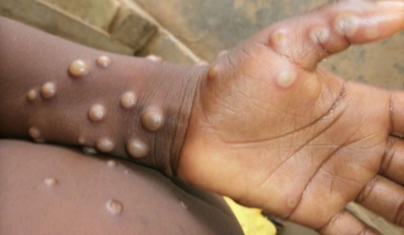 Rondônia registra seis notificações de Mpox Rondônia registra seis notificações de Mpox