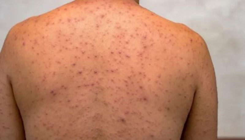 Mpox: Brasil registra 136 casos em cinco novos estados Mpox: Brasil registra 136 casos em cinco novos estados