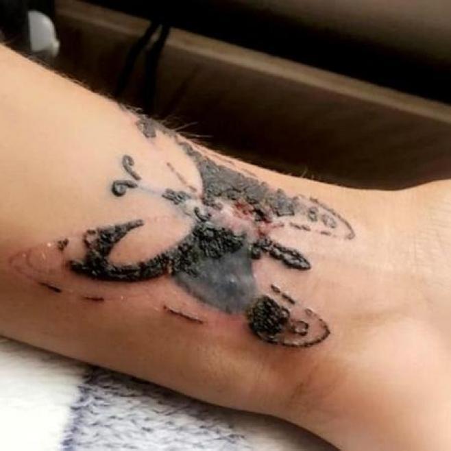Após fazer tatuagem jovem perde o movimento do braço Após fazer tatuagem jovem perde o movimento do braço