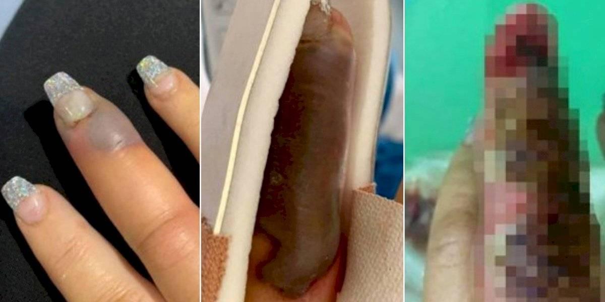Mulher quase perde o dedo por infecção após manicure Mulher quase perde o dedo por infecção após manicure
