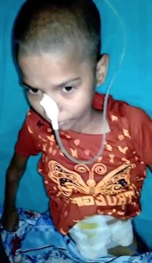 Cirurgia retira massa de cabelo de 1,4kg em estômago de adolescente Cirurgia retira massa de cabelo de 1,4kg em estômago de adolescente