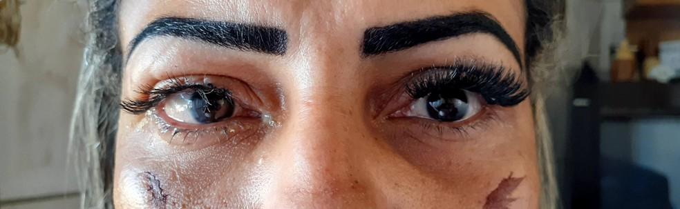 Mulher sofre lesões nos olhos após colocar cílios postiços em clínica de estética de Porto Velho Mulher sofre lesões nos olhos após colocar cílios postiços em clínica de estética de Porto Velho