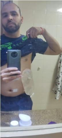 Médico coloca luva cirúrgica no lugar de bolsa de colostomia em paciente 