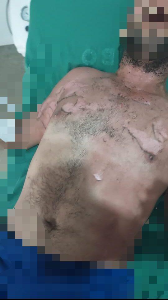 NOVA BRASILÂNDIA: Mulher ateia fogo no namorado após discussão NOVA BRASILÂNDIA: Mulher ateia fogo no namorado após discussão